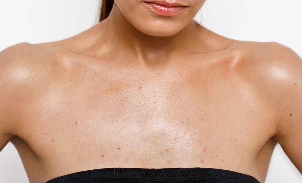 5 Easy Ways To Prevent Chest Pimples ( Acne )