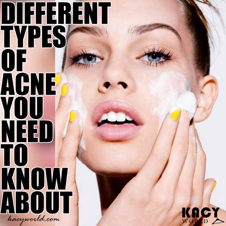 Acne Types and Treatments: Everything You Need to Know