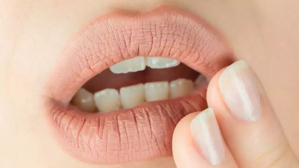 How To Get Rid Of Dark Lips: 5 DIY Remedies You Must Try